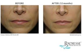 nasoloabial smile line fillers botox nyc